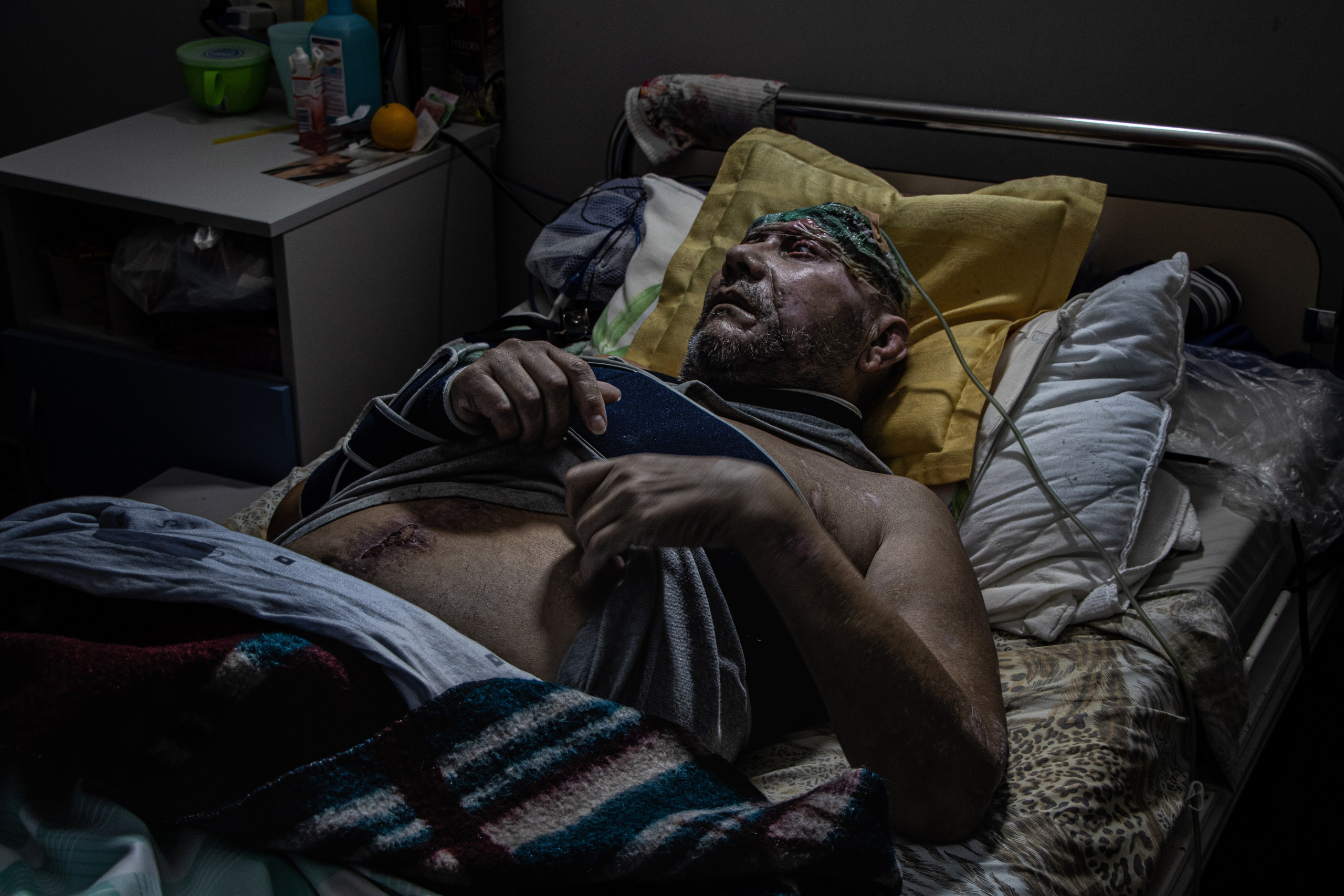 Dans un hôpital de Lviv, le département des grands blessés traite les conséquences physiques et émotionnelles des affrontements en Ukraine. L’intensité des blessures subies, souvent causées par des bombardements ou des combats rapprochés, montre l’ampleur du conflit.