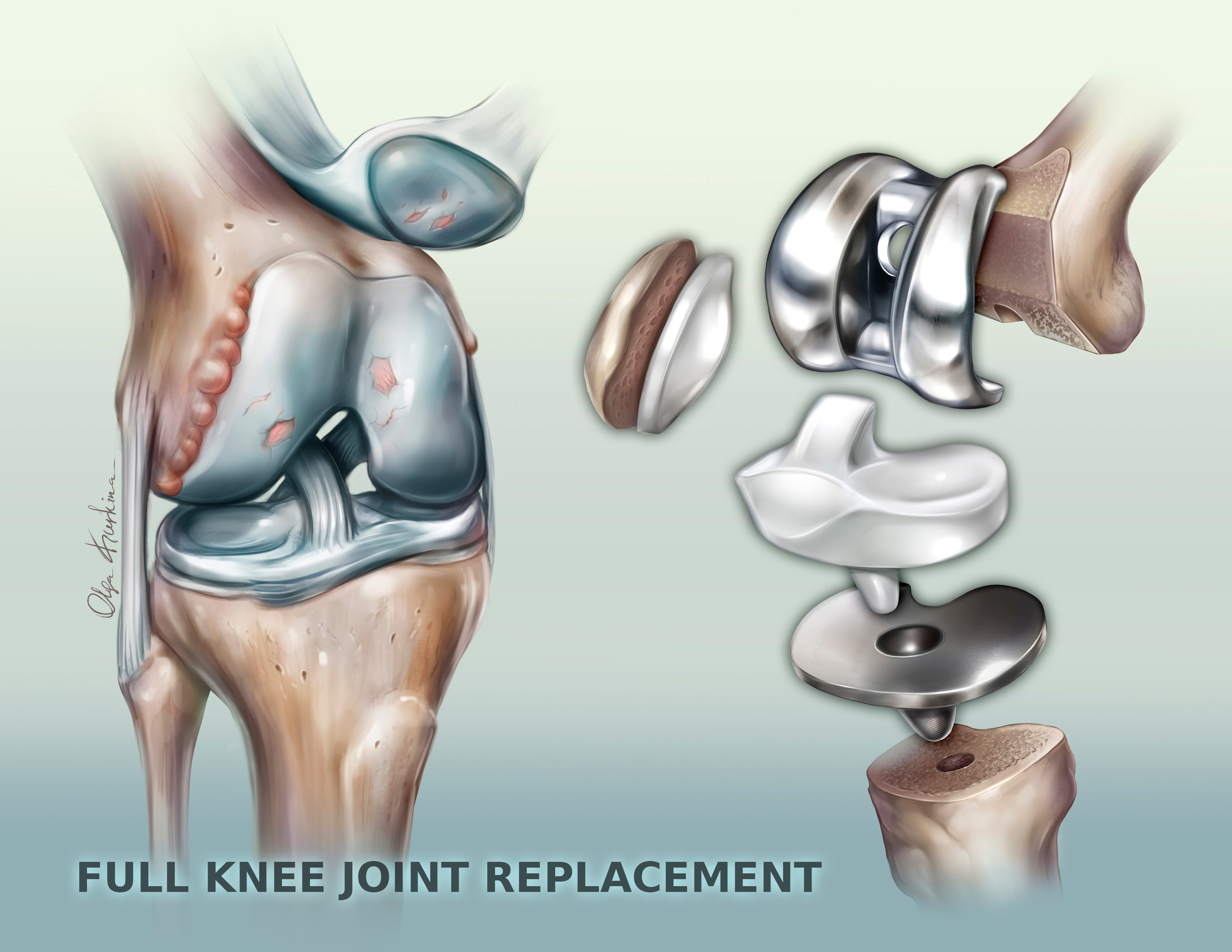 Detailed medical illustration of full knee replacement procedure