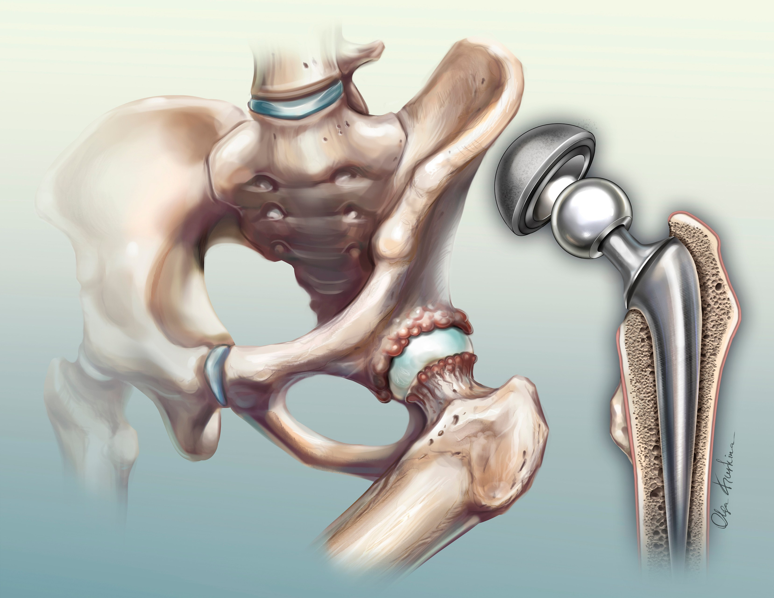 Detailed medical illustration of total hip replacement procedure