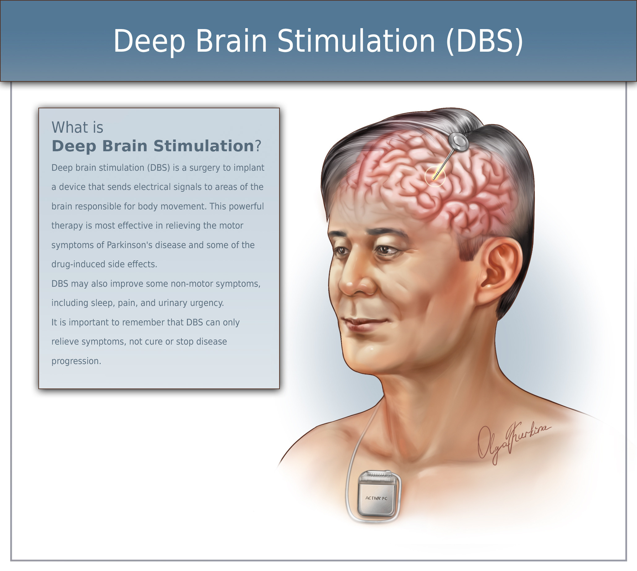 Medical illustration of deep brain stimulation (DBS) showing the placement of electrodes in specific areas of the brain, connected to a neurostimulator device implanted in the chest. The image highlights how DBS is used to treat neurological conditions like Parkinson's disease, illustrating the electrical impulses sent to regulate abnormal brain activity.