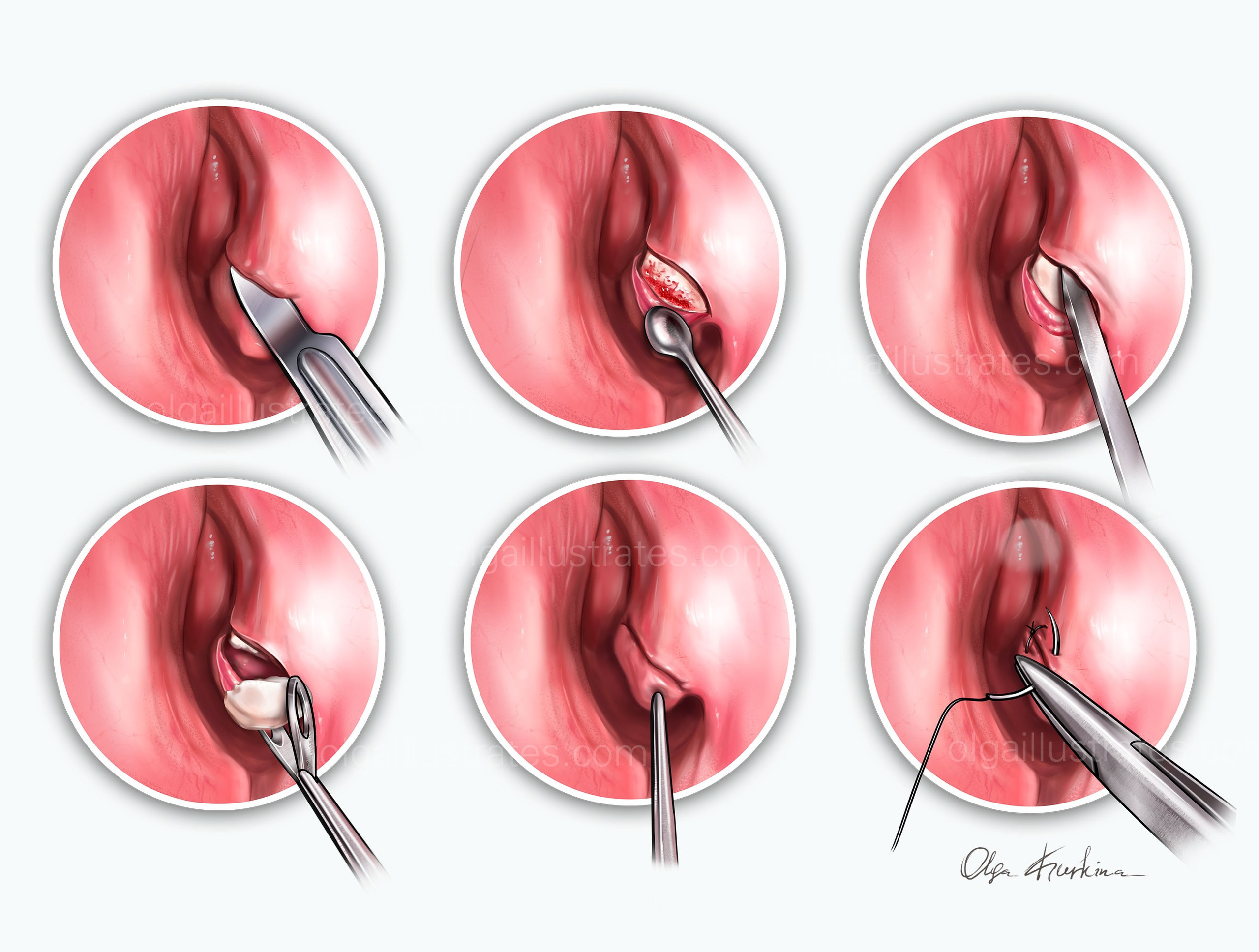 Detailed medical illustration Pyriform Turbinoplasty procedure