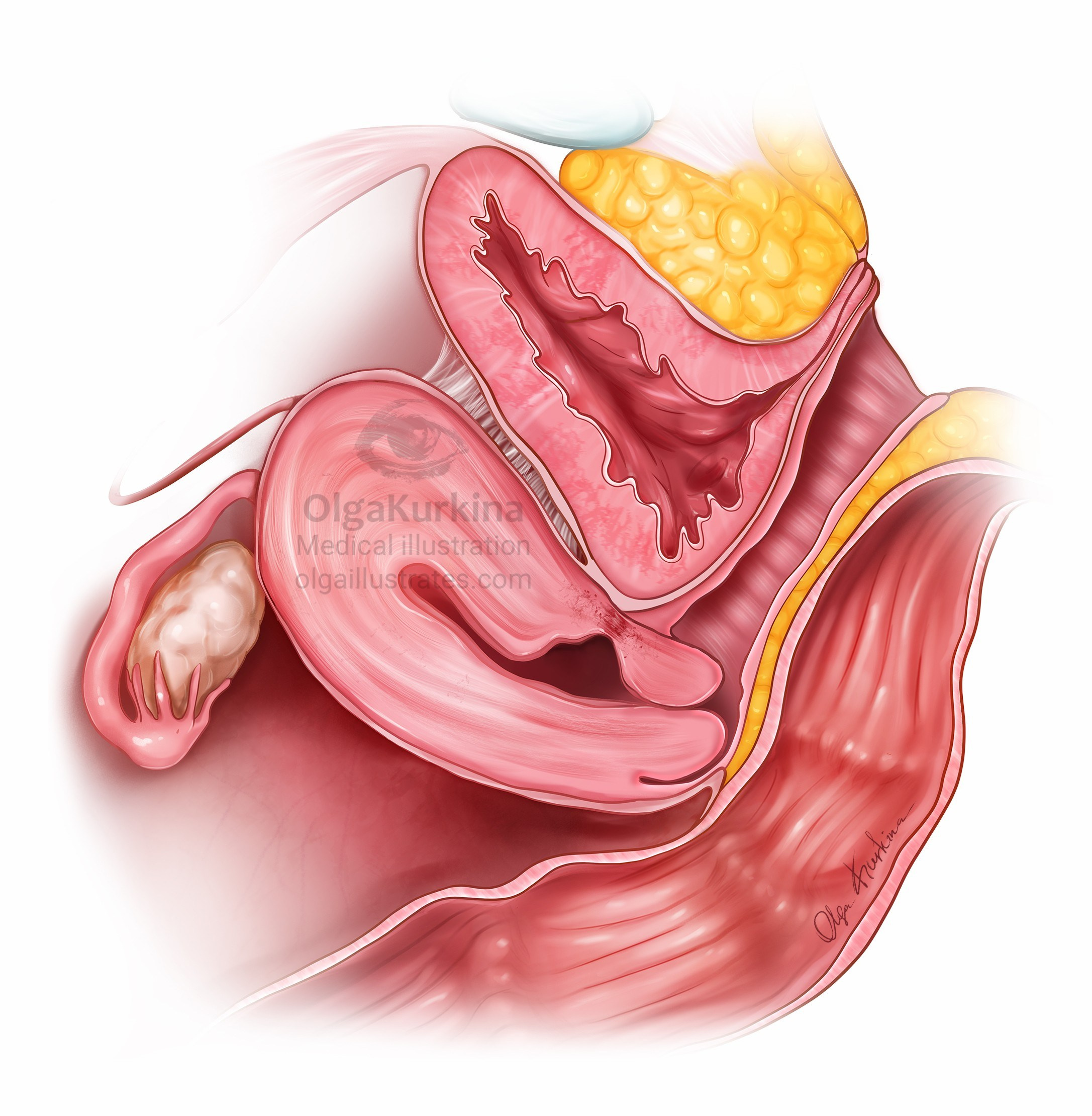 Detailed medical illustration of cesarean scar defect.