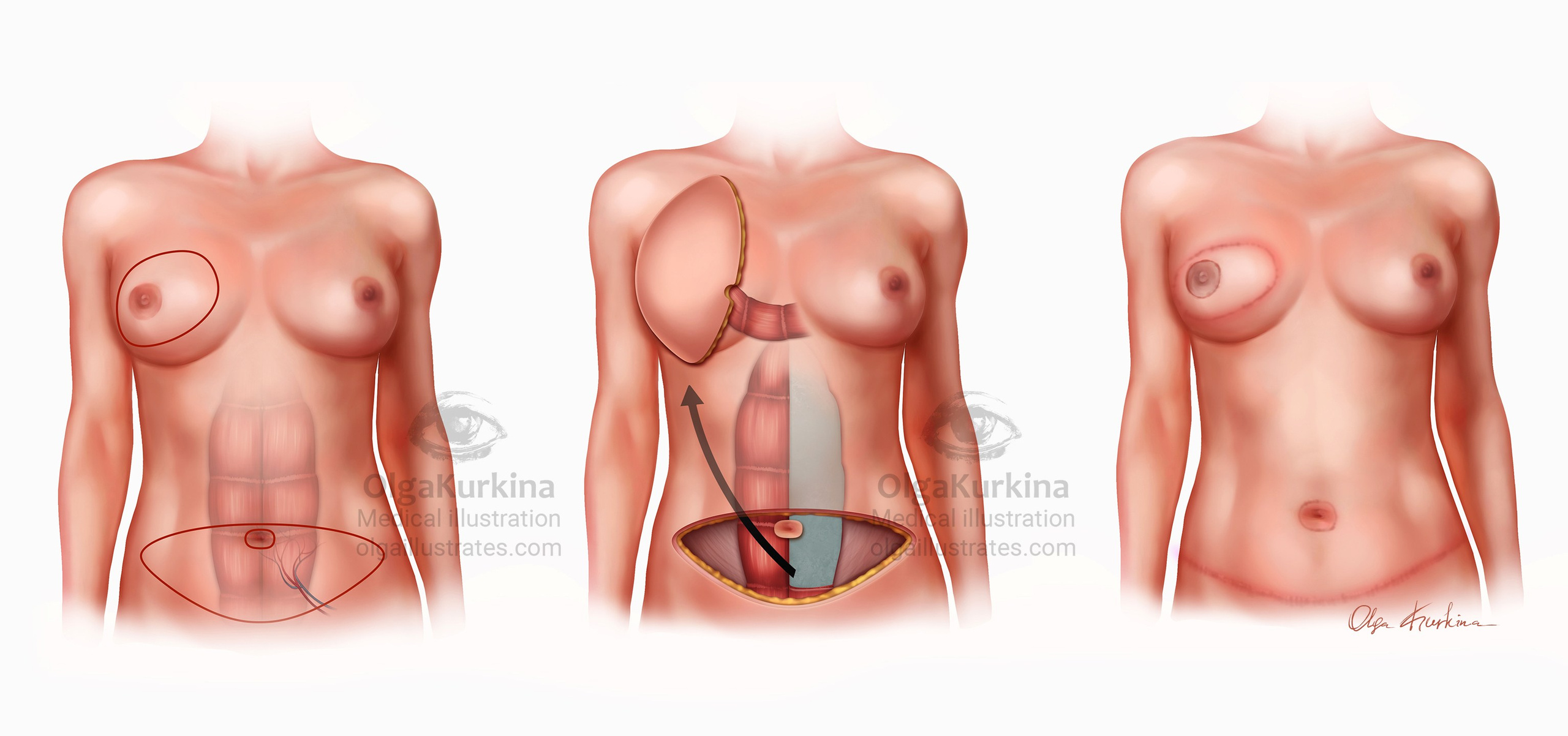 onko plastic surgery illustration