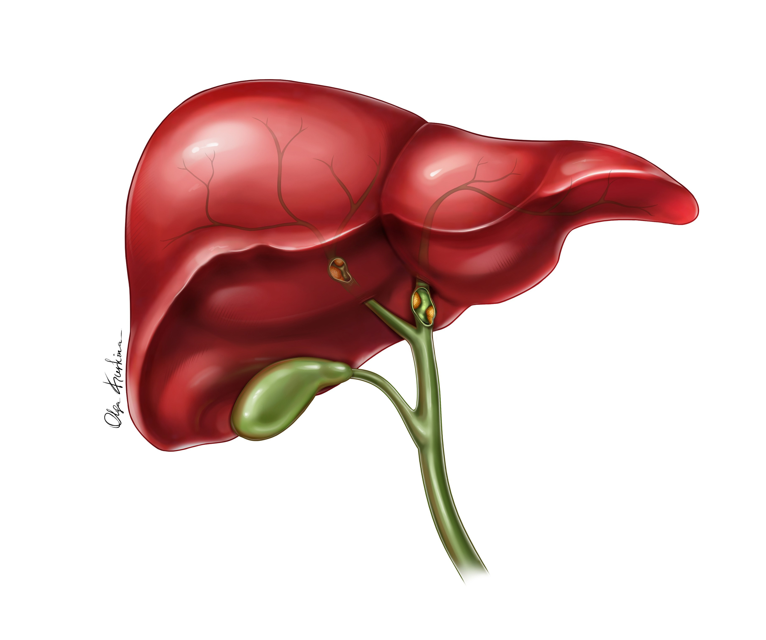 Detailed medical illustration of liver with bile duct cancer