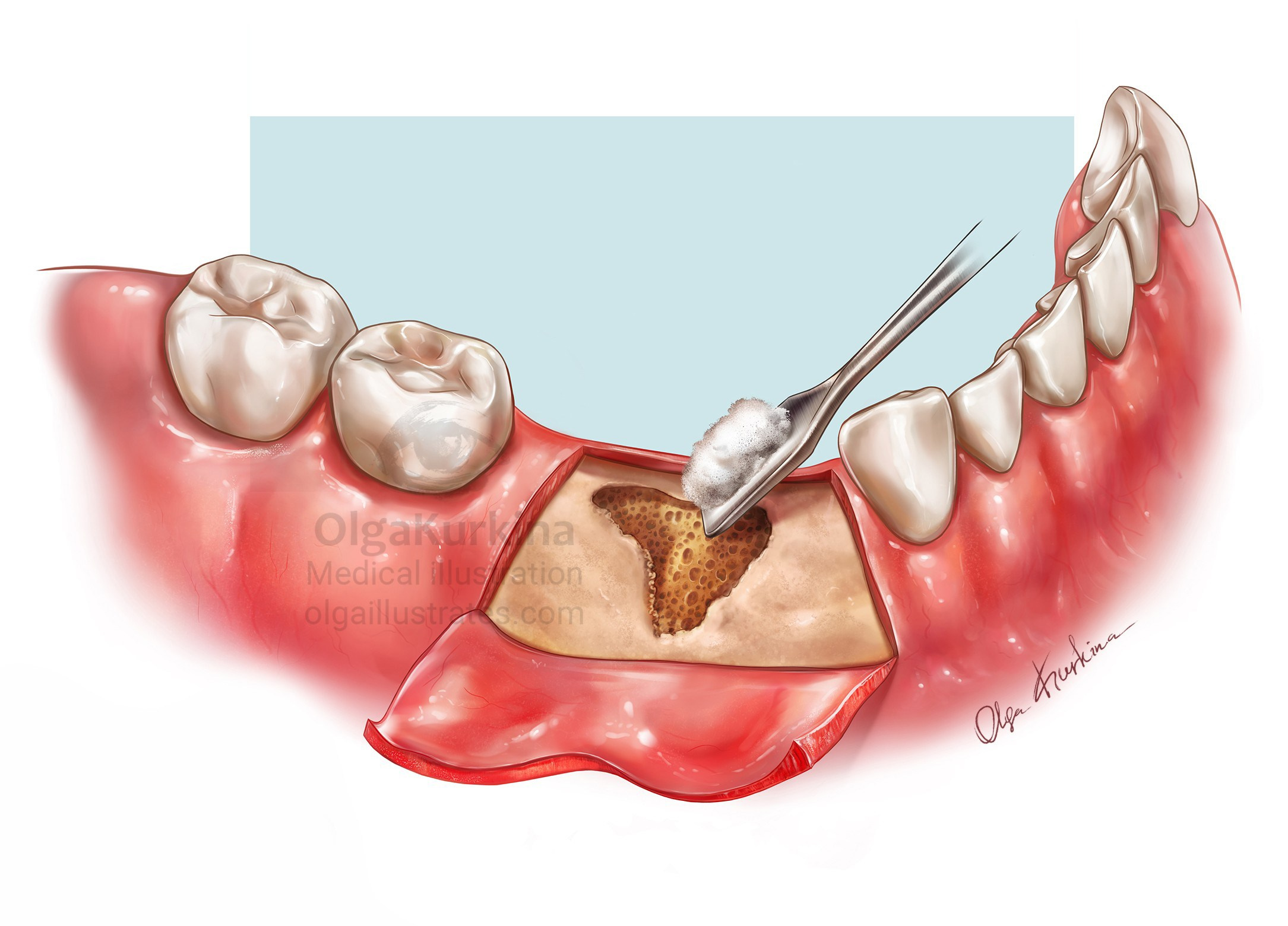 Detailed medical illustration of dental graft procedure