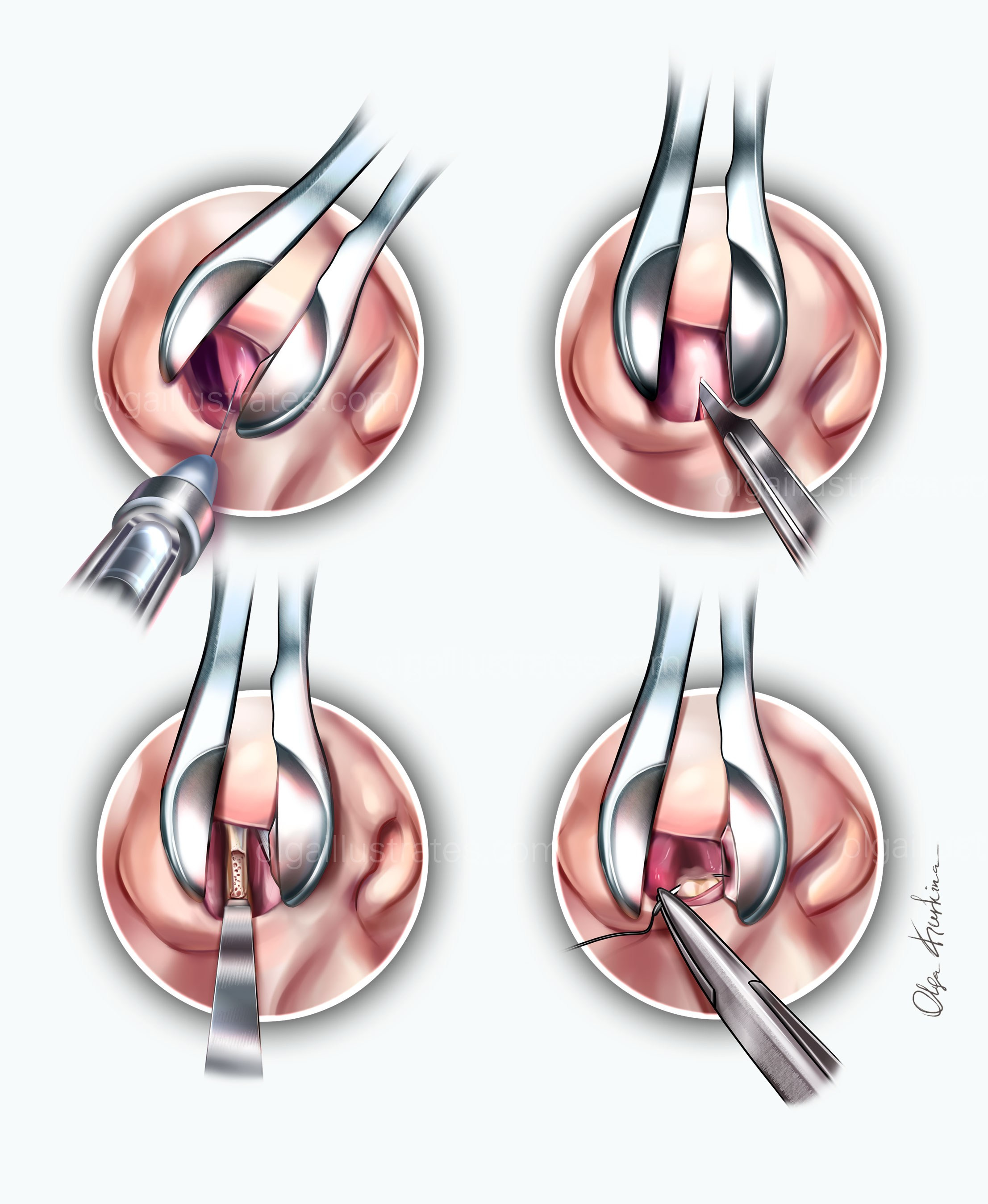 Detailed medical illustration Septoplasty procedure