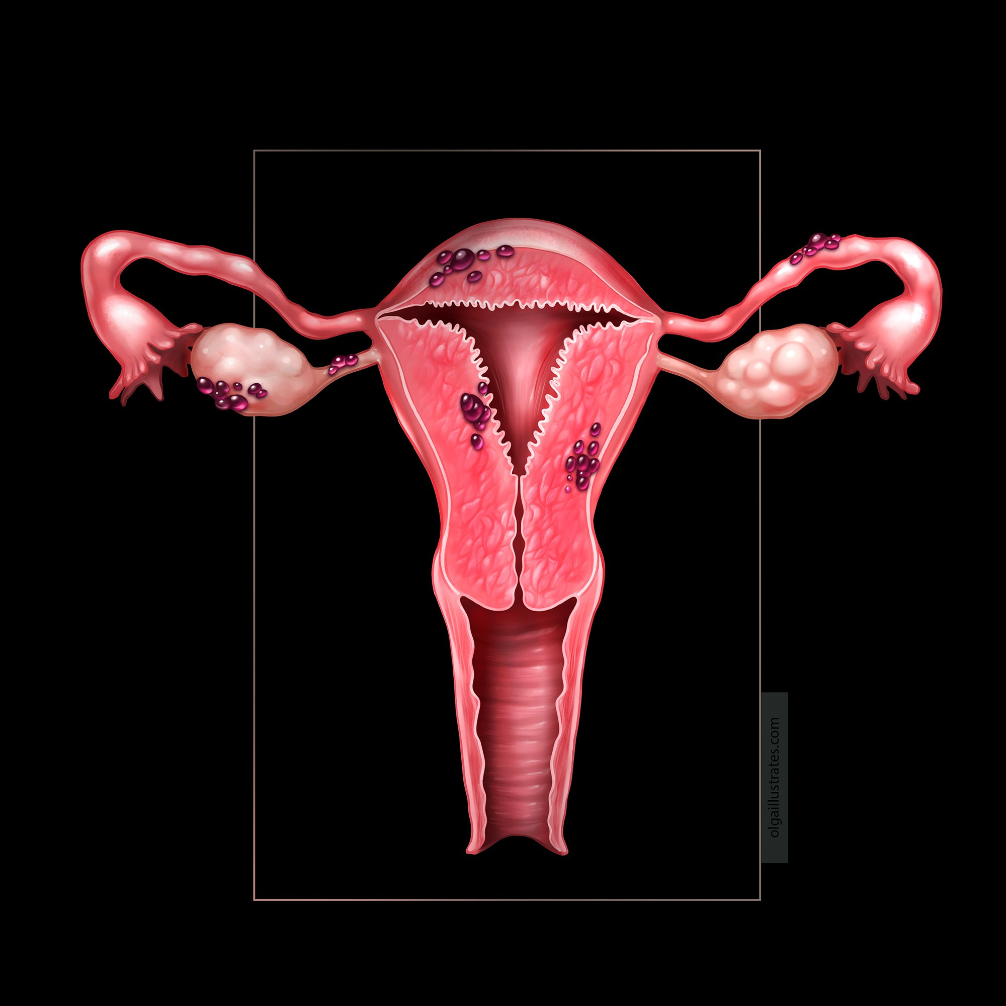 Medical illustration Utery with endometriosis