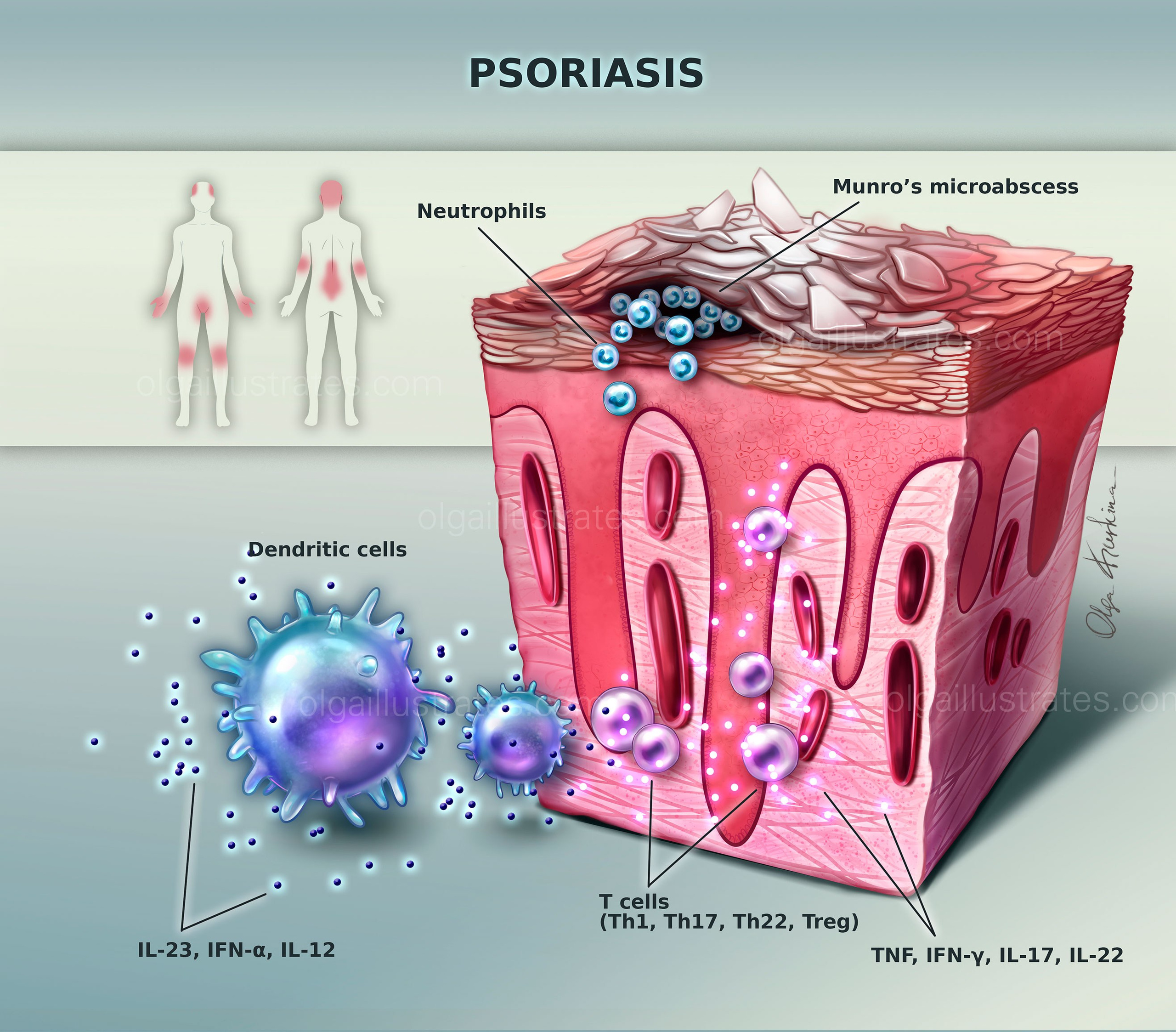 Psoriasis deatiled medical poster