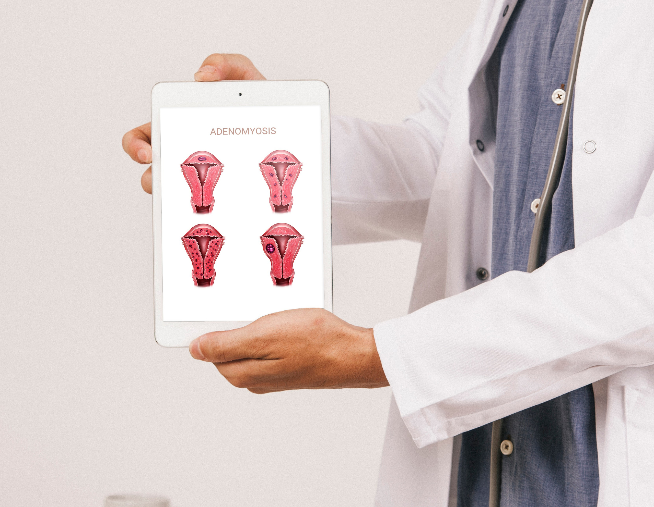 Detailed medical illustration of uterus adenomiosis types on educational platform