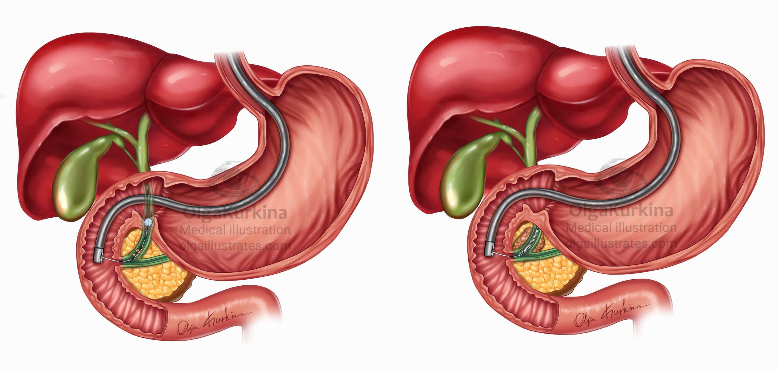 Medical illustration showing placement of a bile duct stent in the digestive system