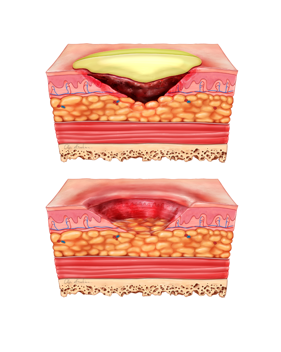 This medical illustration shows a wound bed with eschar and the surrounding skin layers, extending into deeper tissue. Such visuals help explain the debridement process - removing non-viable tissue while protecting healthy structures - to support better wound care education.