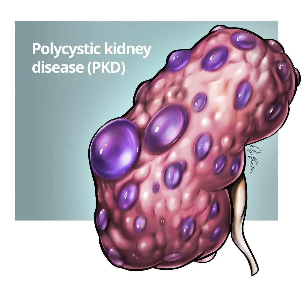 Detailed medical illustration of Polycystic kidney desease.