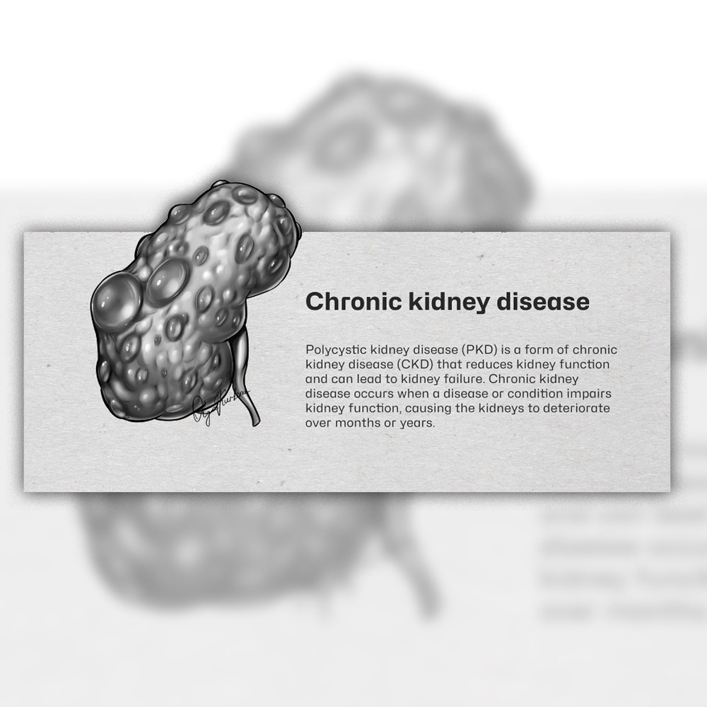 Freelance medical illustrator black&white kidney illustration polycystic