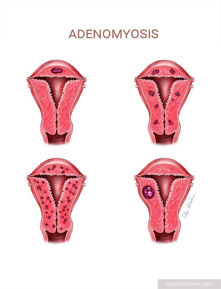 Detailed medical illustration of uterus adenomiosis types