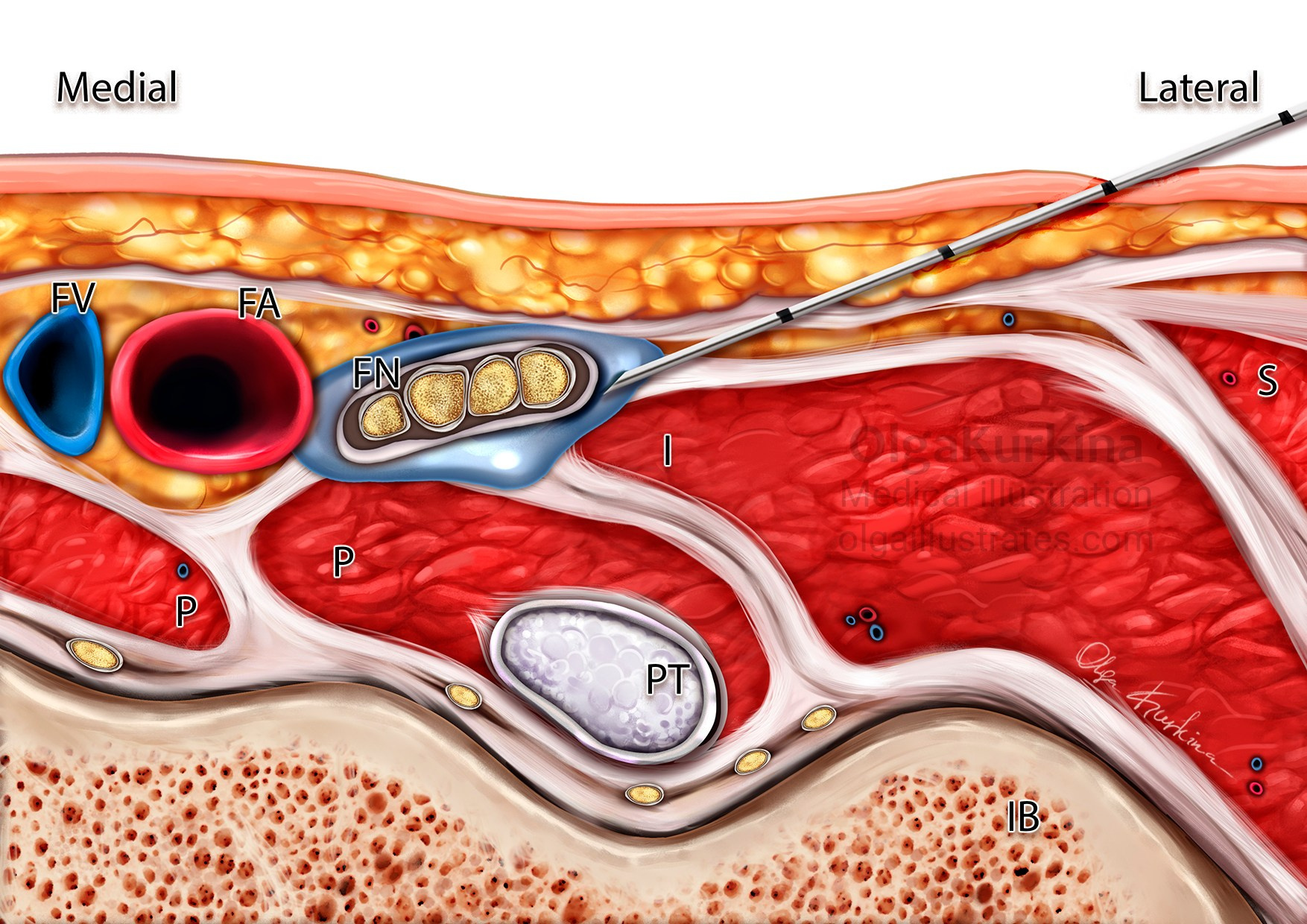 Detailed medical illustration highlights the PENG nerve block, an approach used to manage hip pain effectively.