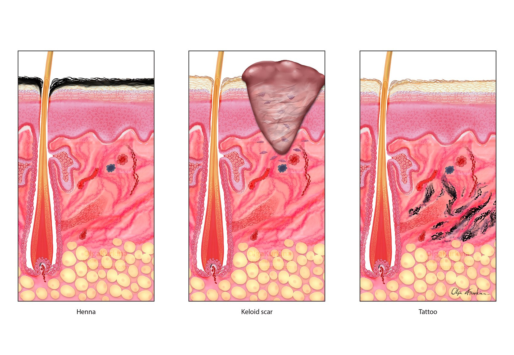 Professional freelance medical illustrator