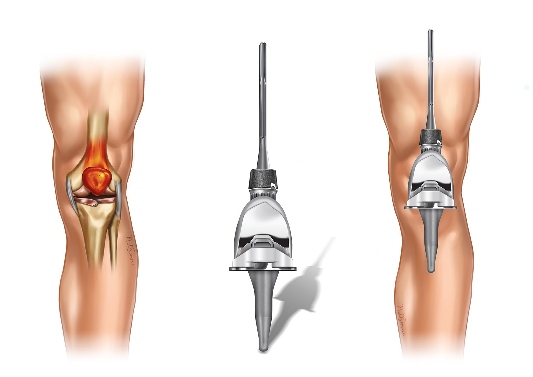 Knee joint replaicement medical illustration
