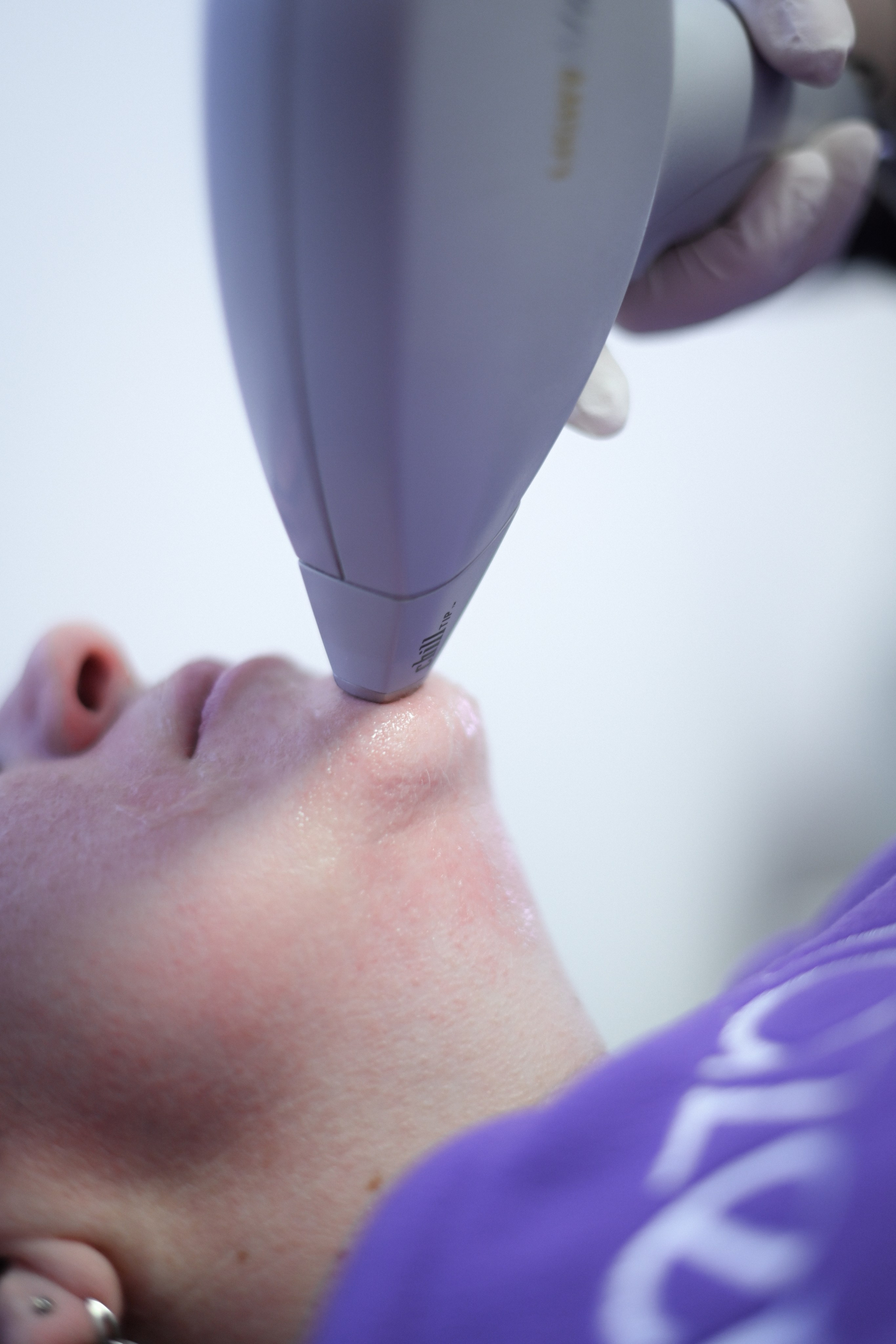 Контент_Лазерная эпиляция. Фотограф Натали Кошевая _ Днепр, Подгородное