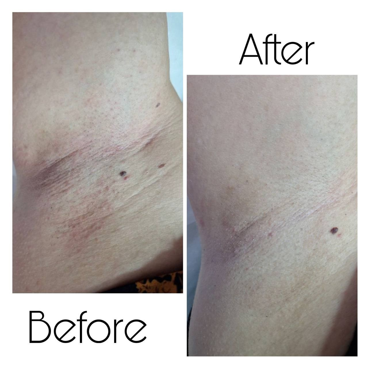 Epilare Laser Asclepion Mediostar Hîncești – Lavime.md. Lavime.md – Salon de Frumusețe Premium în Hîncești