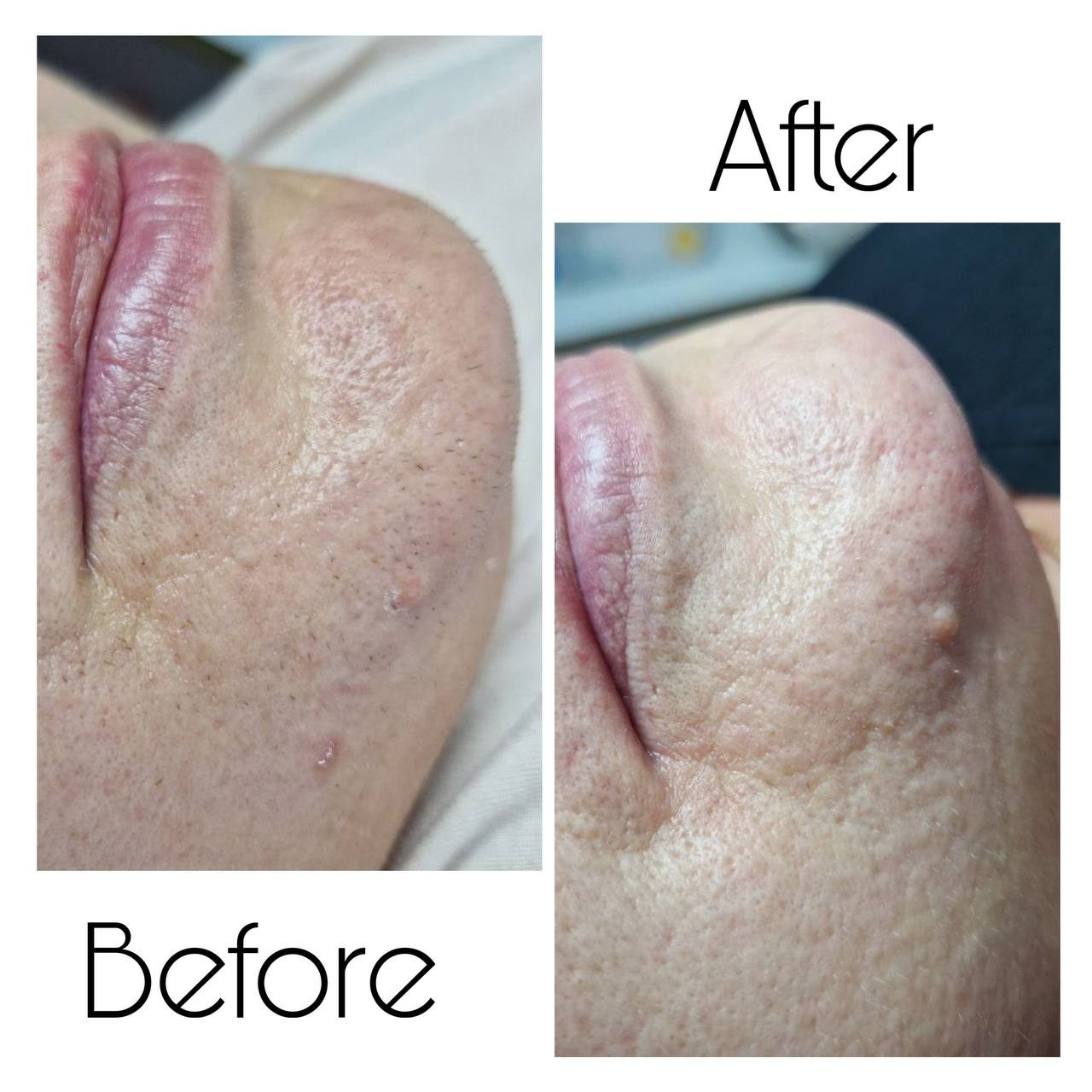 Epilare Laser Asclepion Mediostar Hîncești – Lavime.md. Lavime.md – Salon de Frumusețe Premium în Hîncești