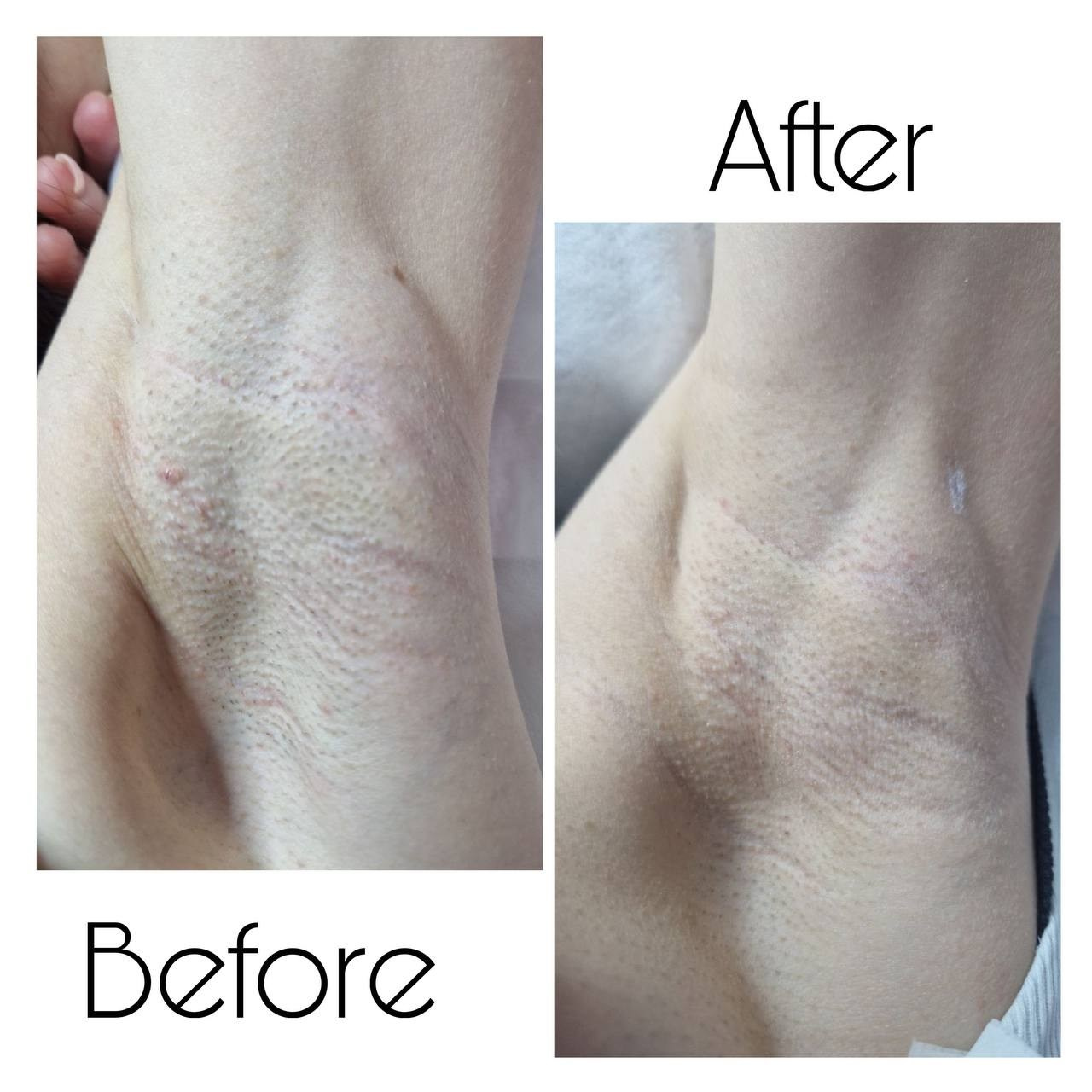 Epilare Laser Asclepion Mediostar Hîncești – Lavime.md. Lavime.md – Salon de Frumusețe Premium în Hîncești