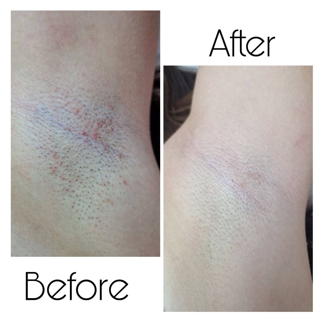 Epilare Laser Asclepion Mediostar Hîncești – Lavime.md. Lavime.md – Salon de Frumusețe Premium în Hîncești