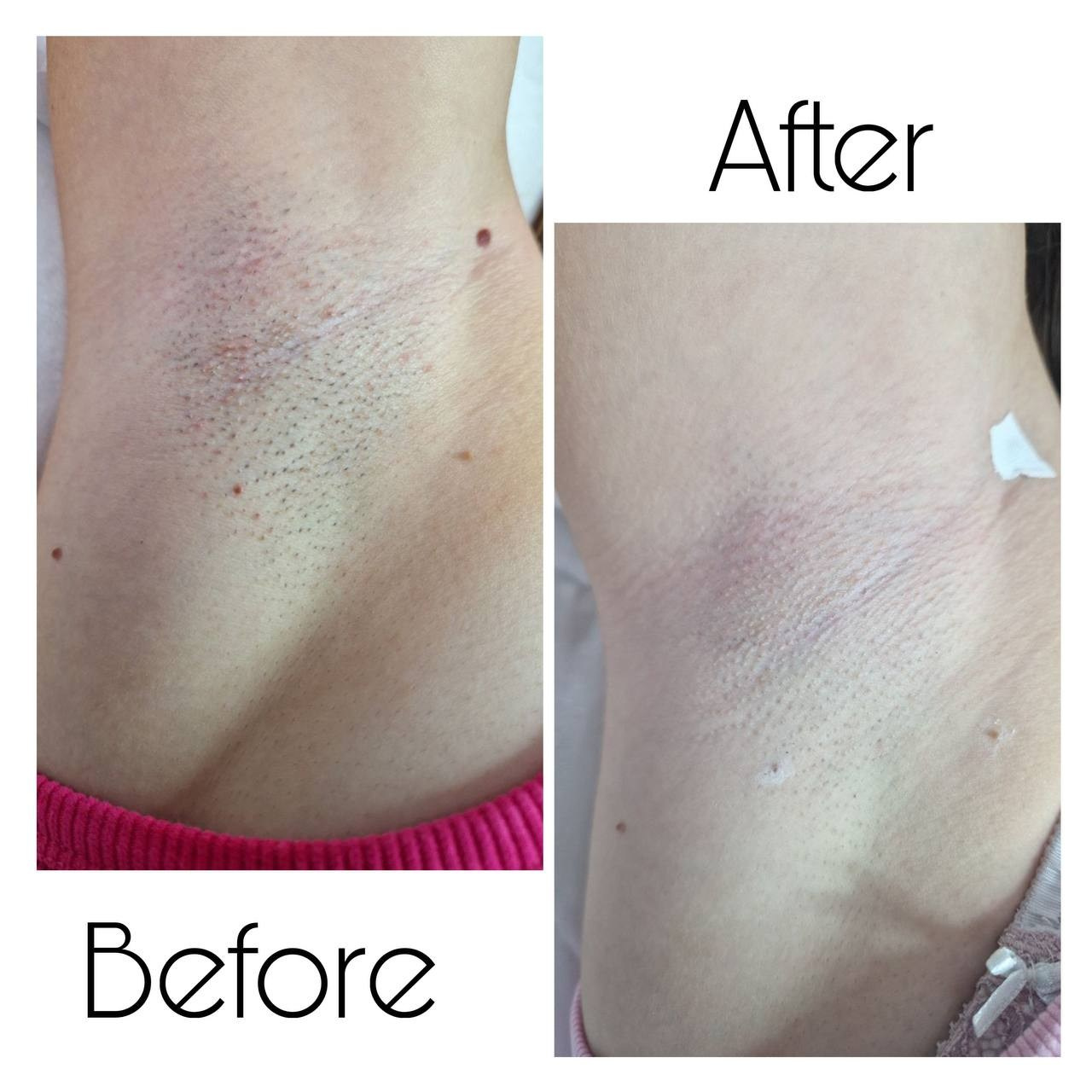 Epilare Laser Asclepion Mediostar Hîncești – Lavime.md. Lavime.md – Salon de Frumusețe Premium în Hîncești