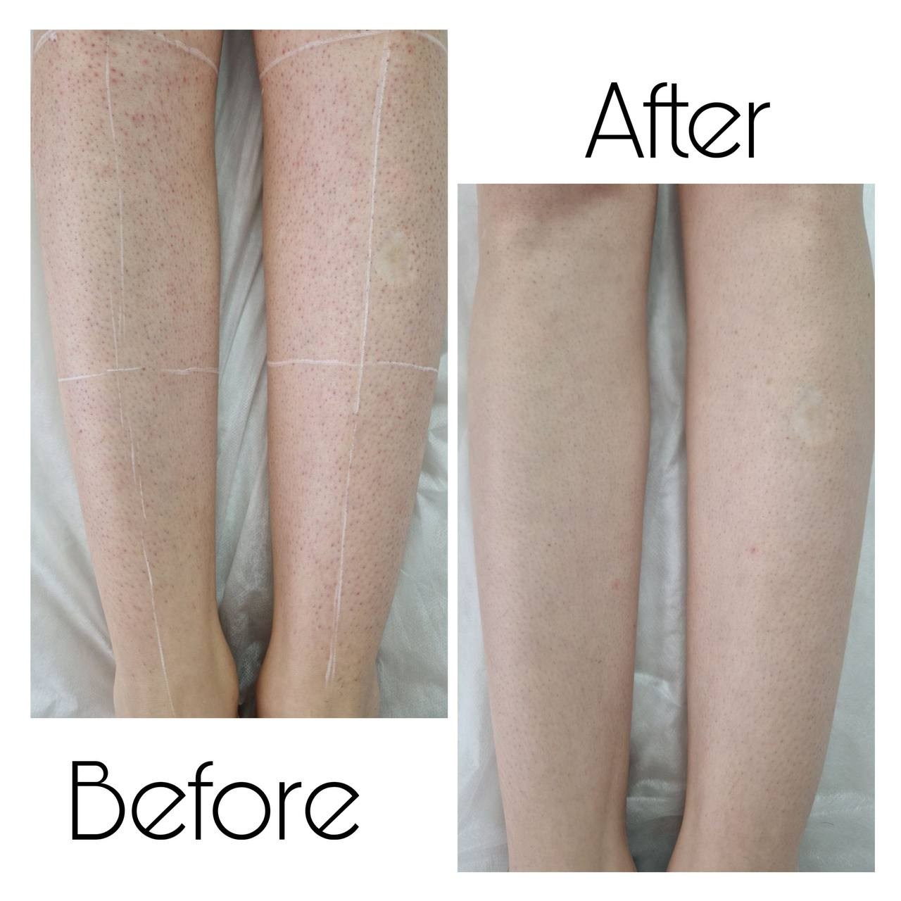 Epilare Laser Asclepion Mediostar Hîncești – Lavime.md. Lavime.md – Salon de Frumusețe Premium în Hîncești