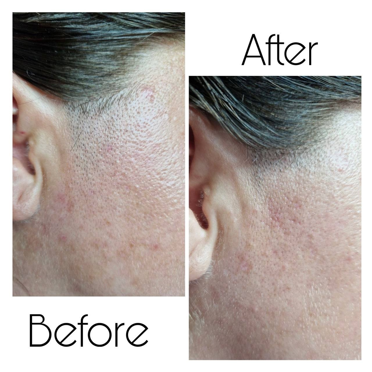 Epilare Laser Asclepion Mediostar Hîncești – Lavime.md. Lavime.md – Salon de Frumusețe Premium în Hîncești