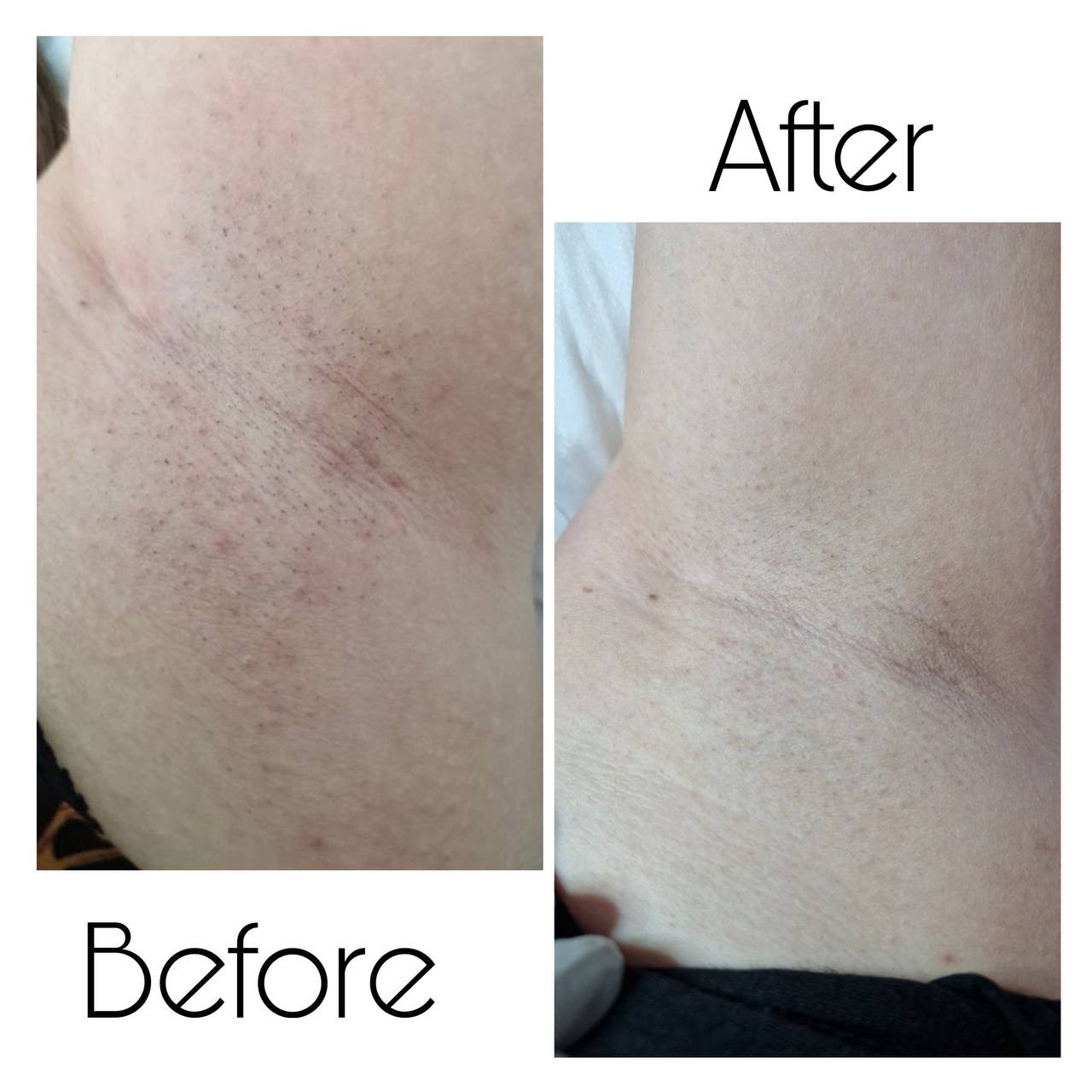 Epilare Laser Asclepion Mediostar Hîncești – Lavime.md. Lavime.md – Salon de Frumusețe Premium în Hîncești