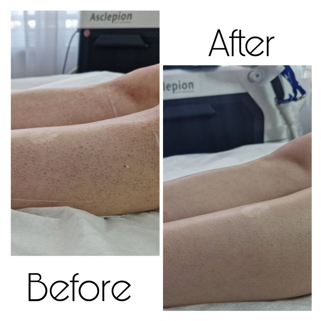 Epilare Laser Asclepion Mediostar Hîncești – Lavime.md. Lavime.md – Salon de Frumusețe Premium în Hîncești