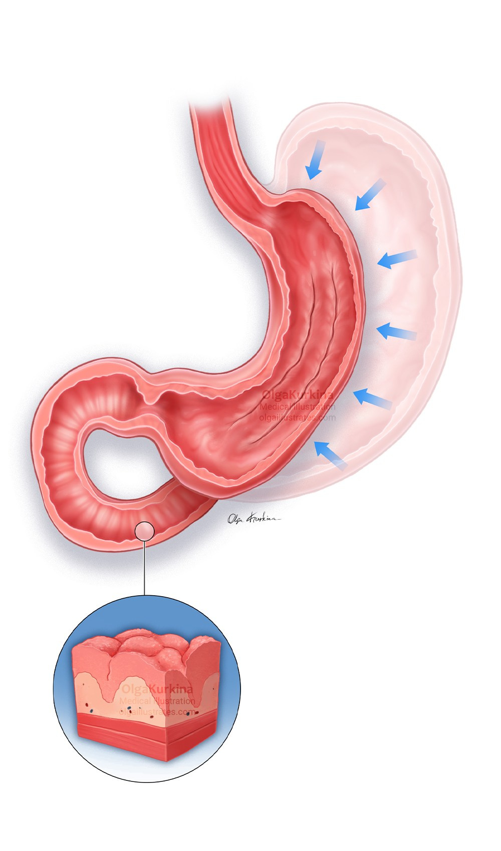 Medical illustration showing the post-procedure anatomy of the stomach after Endoscopic Sleeve Gastroplasty (ESG) combined with Gastric Fundal Mucosal Ablation (GFMA) and Endoscopic re-cellularization via electroporation therapy