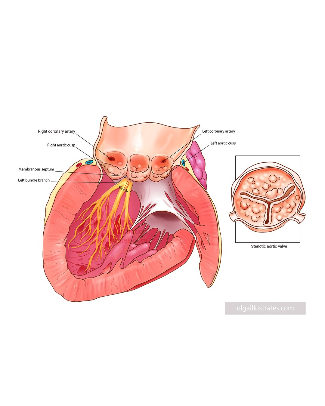  Medical illustration showing how stenotic (narrowed) aortic valve leads to left bundle branch block (LBBB)