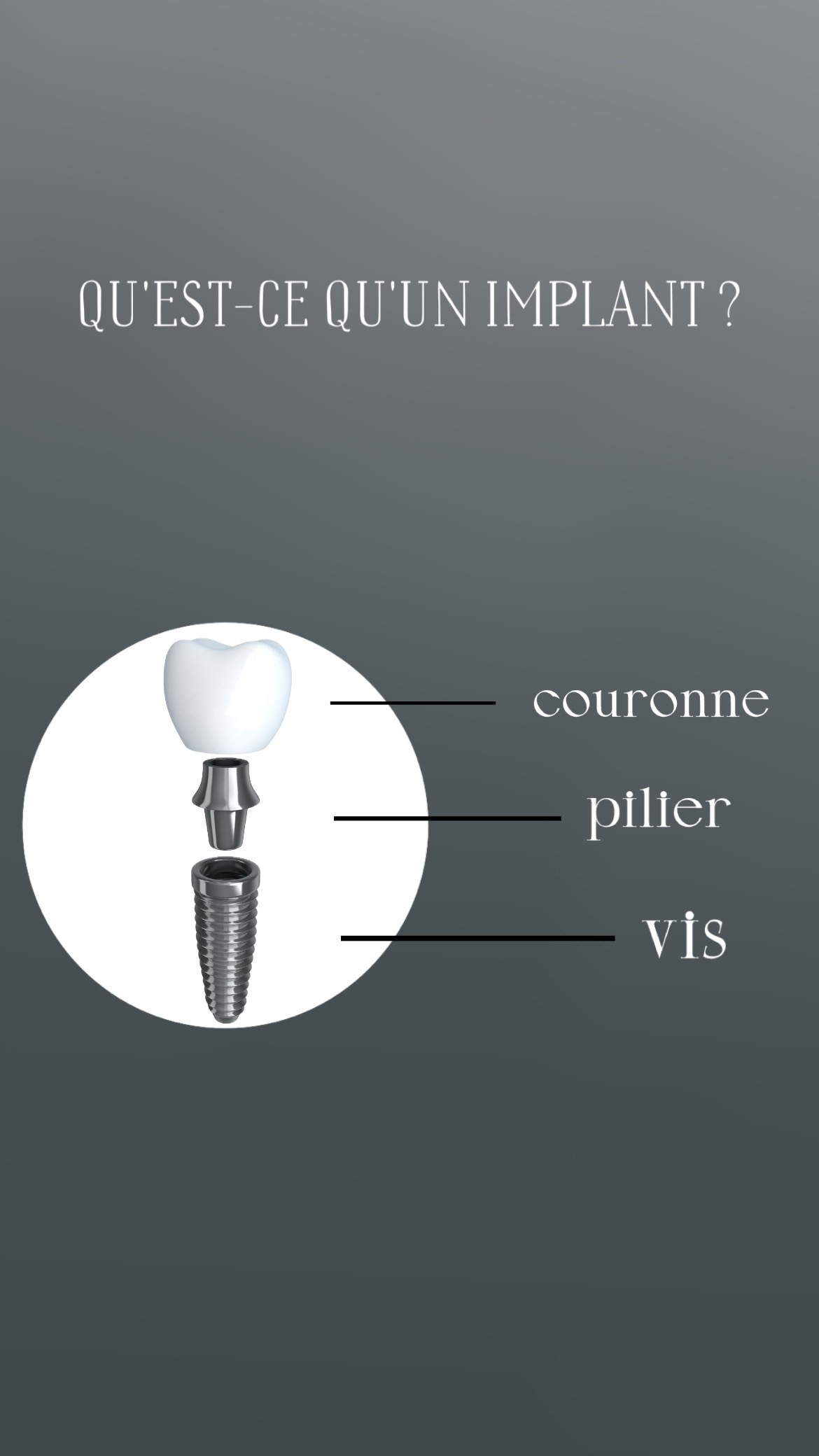 Implants dentaires. TA Dent