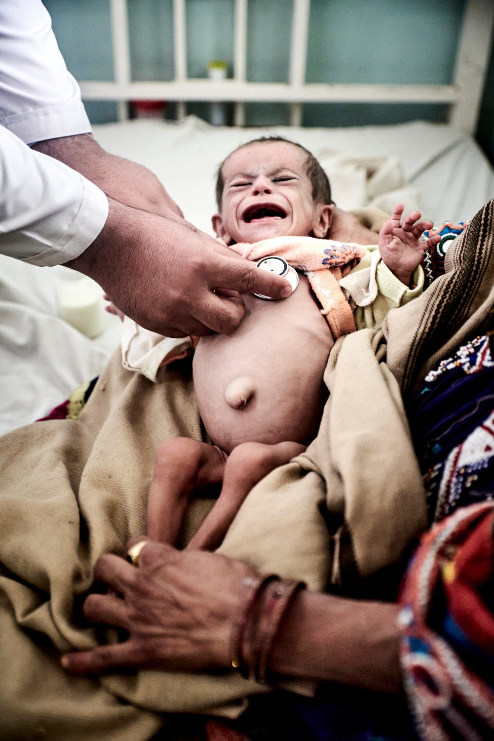Kandahar, 17 novembre 2021 – Un médecin ausculte un enfant atteint de malnutrition sévère, à l'hôpital régional Mirwais de Kandahar.