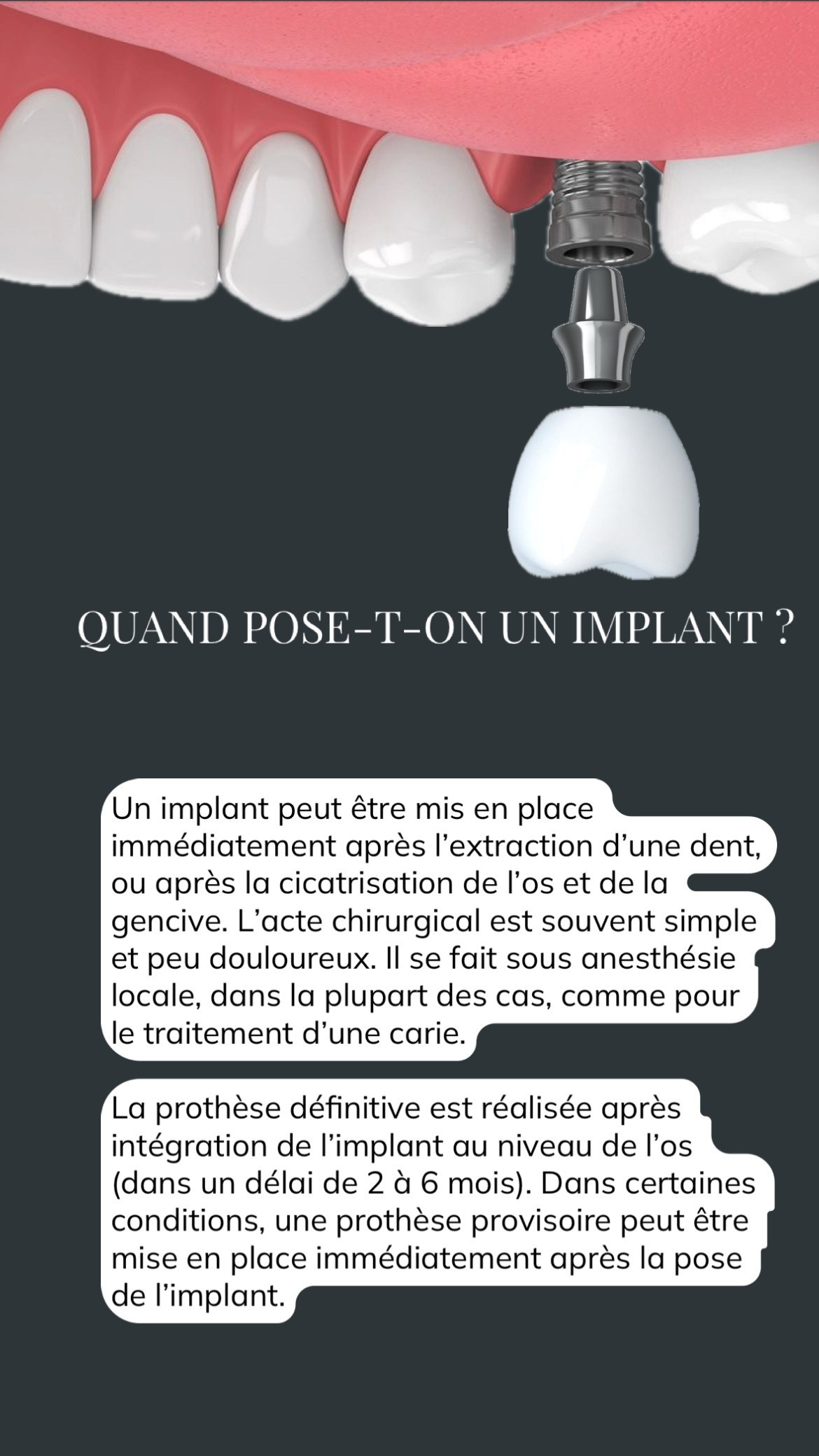 Implants. TA Dent