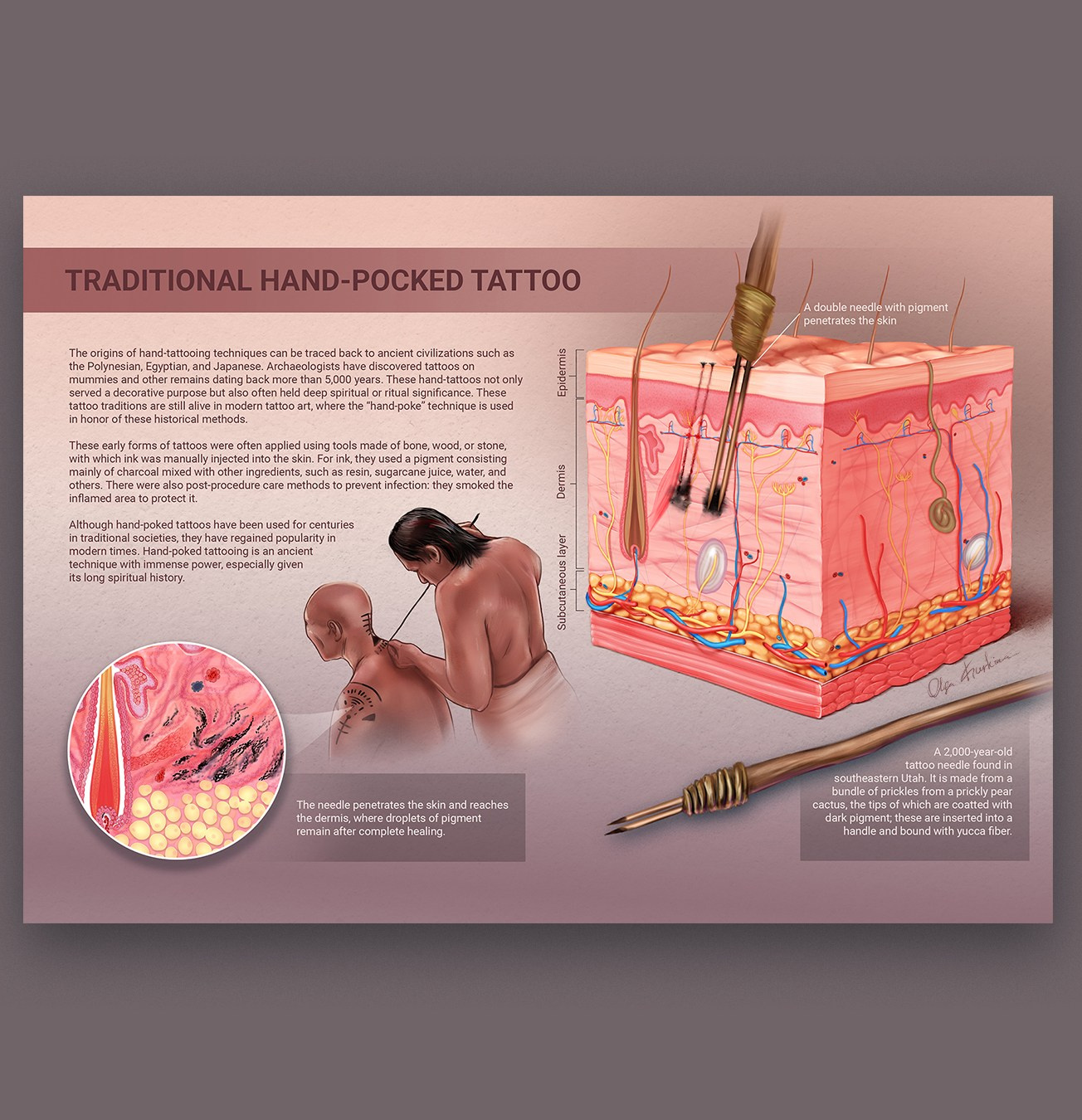 The illustration depicts the process of traditional hand tattooing using traditional tools. Drops of pigment are injected deep into the dermis using needles and remain there among the collagen and elastin fibers after complete healing. This can be seen in the histological illustration on the left.