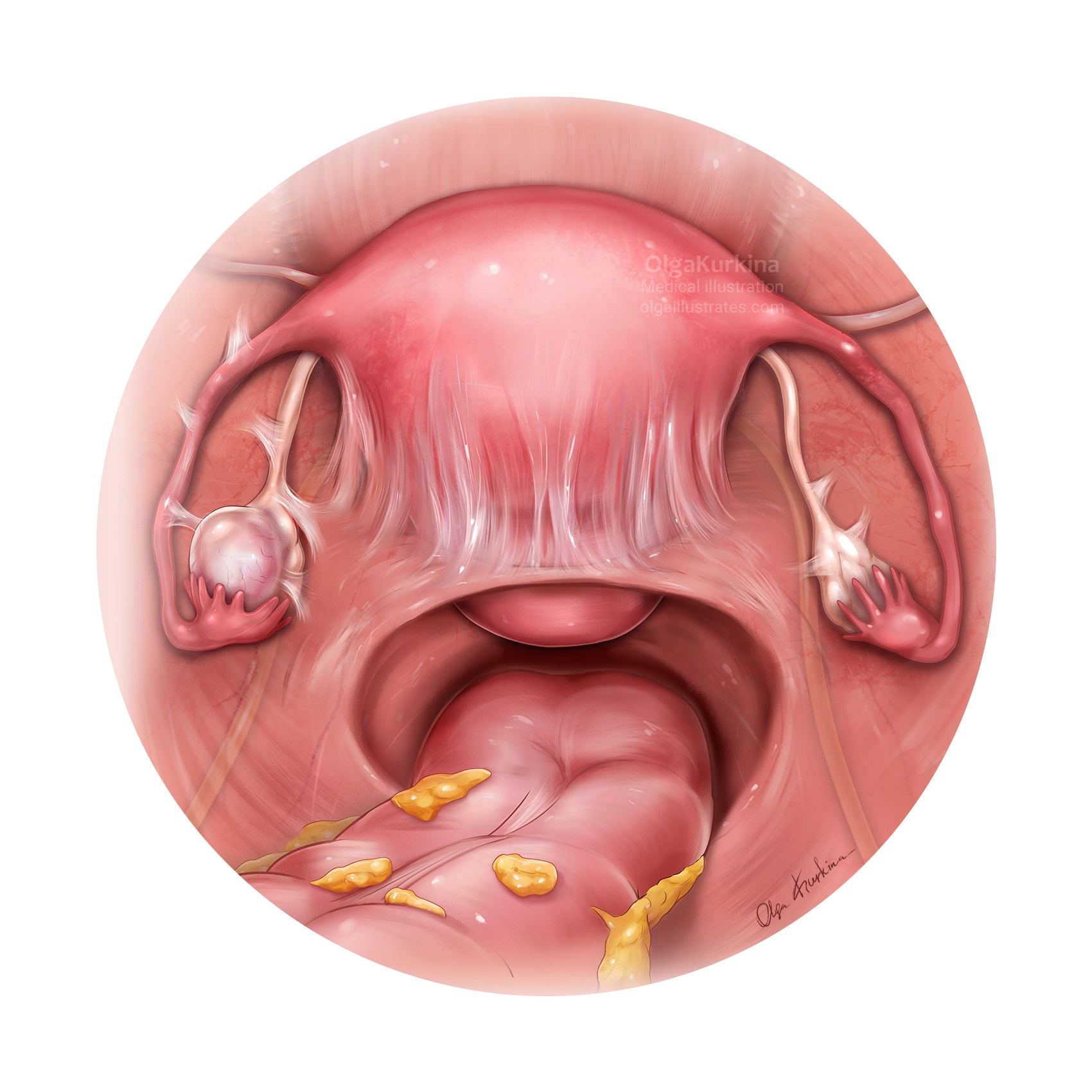 Laparoscopic View of Deep Endometriosis with Ovary affected.Medical illustration created to support surgical education and improve visual understanding of complex gynecological pathology.